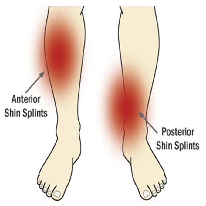 Сильные боли ноги ниже колена причины. Болит голень спереди. Болит голень при ходьбе.