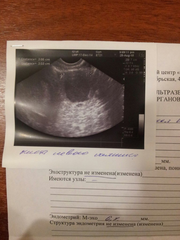 Тянет яичник при беременности на ранних. УЗИ беременности на ранних. Снимки УЗИ на ранних сроках. Снимок УЗИ беременности на ранних сроках. Отсутствие беременности на УЗИ.