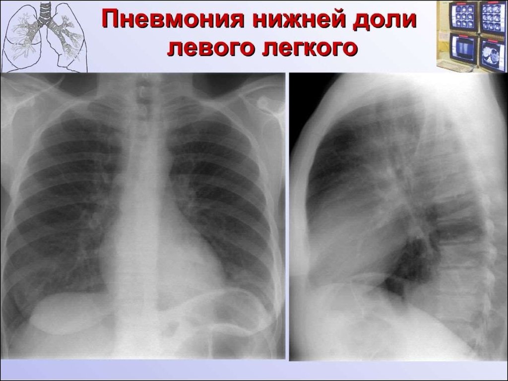 Пневмония в правом легком в нижней доле. Внебольничная нижнедолевая пневмония рентген. Нижнедолевая очаговая пневмония рентген. Левосторонняя нижнедолевая пневмония рентген. Пневмония нижней доли левого легкого рентген.