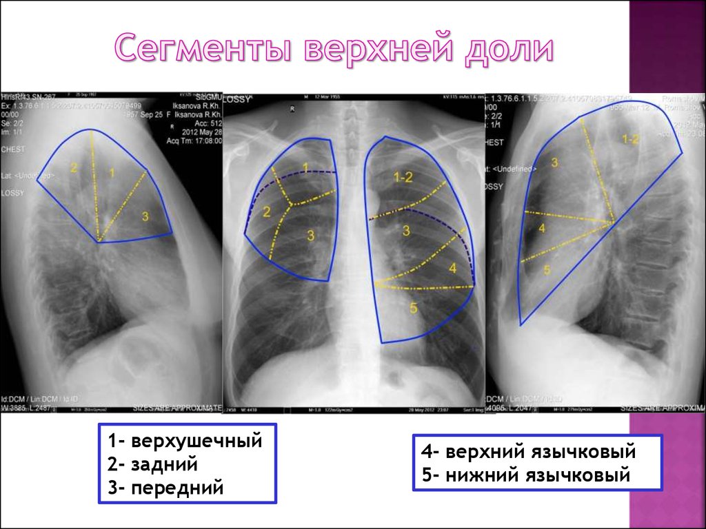 Язычковые сегменты левого. Рентгеноанатомия грудной клетки. Сегменты s1 s2 легких. Сегменты легкого s1 s2. Сегменты легких схема.