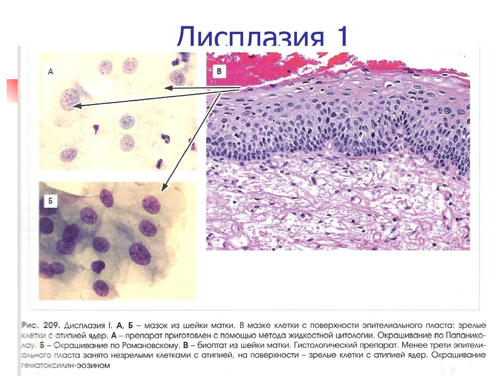 Клетки с признаками реактивных изменений. Дисплазия шейки матки микропрепарат. Дисплазия эпителия гистология. Дисплазия шейки матки HPV. Дисплазия шейки матки 2 степени гистология.