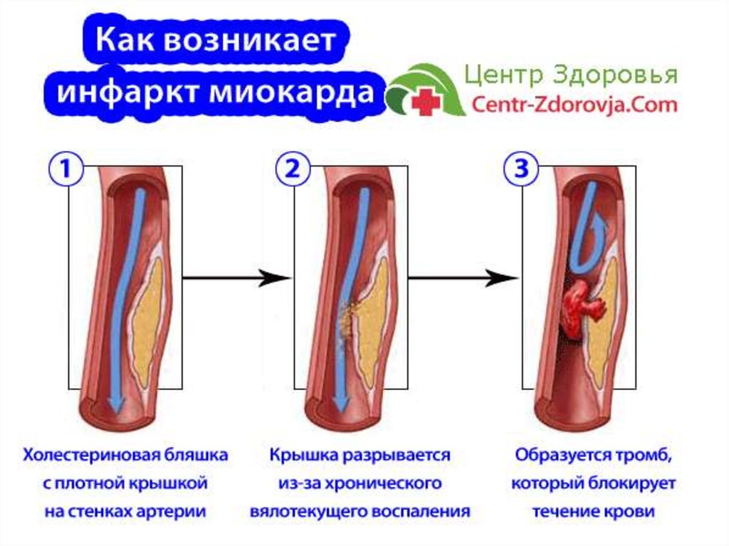 Тромб и бляшка разница. Развитие инфаркта миокарда. Бляшки инфаркт миокарда. Инфаркт перенесенный на ногах.