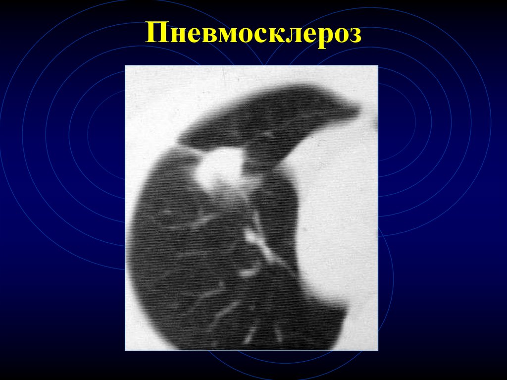 Диффузный пневмосклероз это рак. Пневмосклероз рентген. Диффузный пневмосклероз рентген. Пневмосклероз легких рентген.