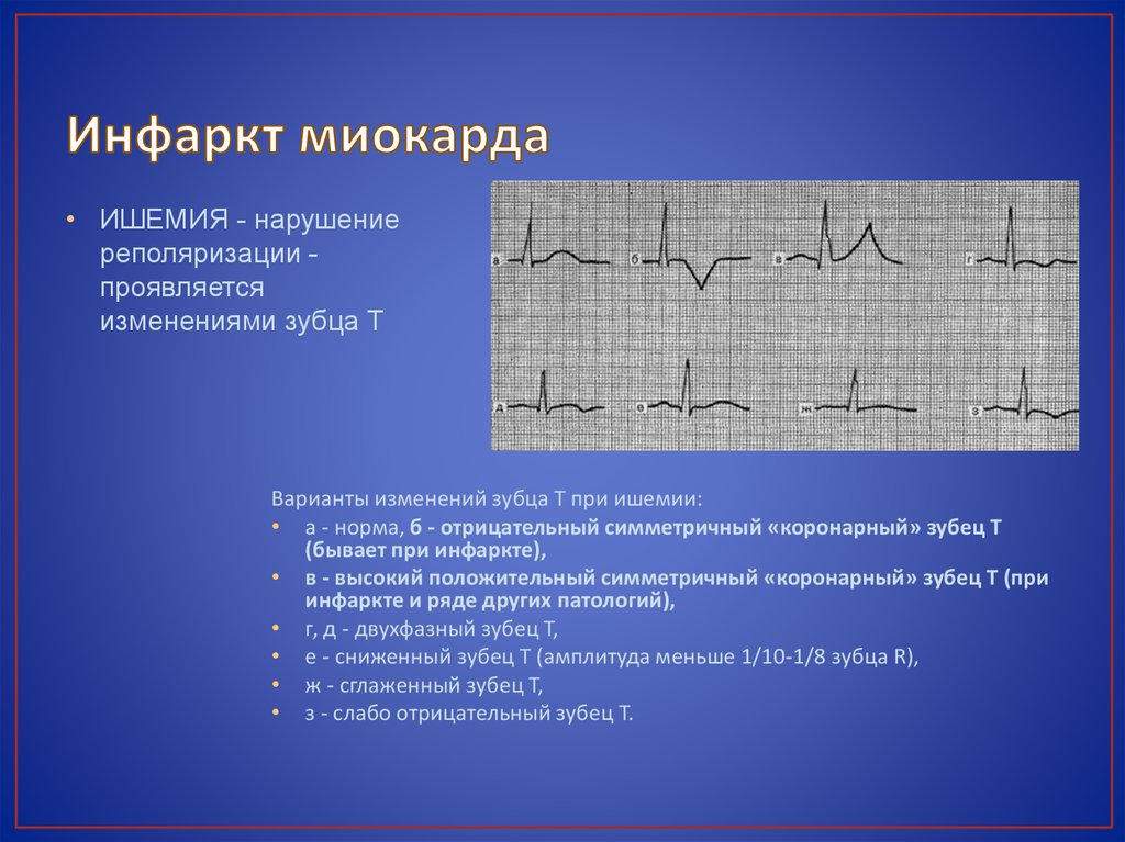 Диффузное нарушение процесса реполяризации сердца. Нарушение процессов реполяризации на ЭКГ. ЭКГ при нарушении процессов реполяризации. Реполяризация миокарда на ЭКГ. ЭКГ при нарушении реполяризации миокарда.