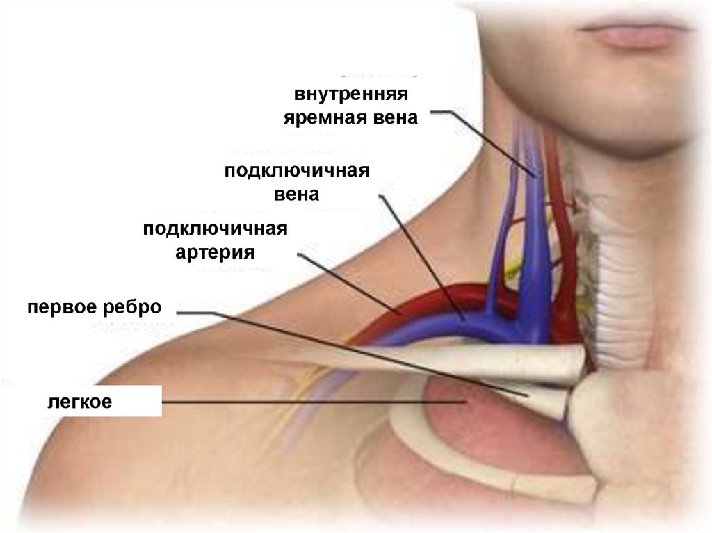 Подключичный тромбоз. Подключичная Вена анатомия. Наружная яремная и внутренняя яремная Вена. Подключичная Вена топография. Внутренняя яремная Вена анатомия.