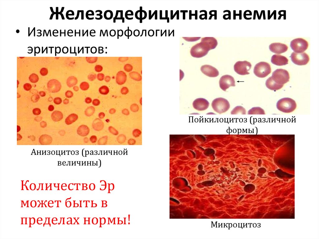 Анемия и эритроциты в крови. Изменение эритроцитов при железодефицитной анемии. Показатели при микроцитарной анемии. Характерные изменения крови при железодефицитной анемии. Морфология эритроцитов при в12.
