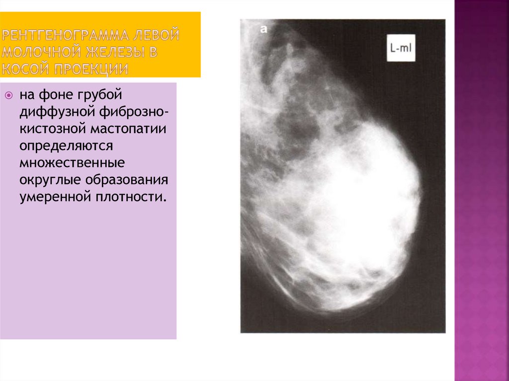 Признаки фиброзных изменений молочных желез. Фиброзная мастопатия маммограмма.