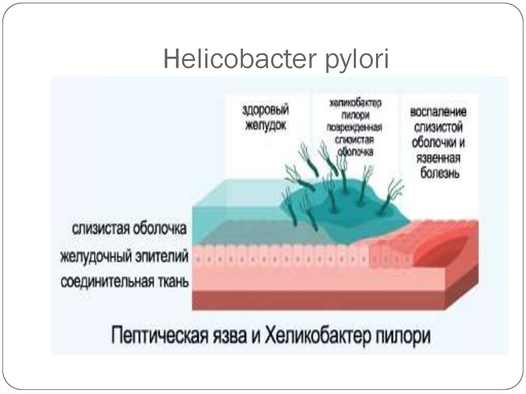 Хеликобактер пилори погибает. Распространенность инфекции h. pylori. Биоптата на Helicobacter pylori.