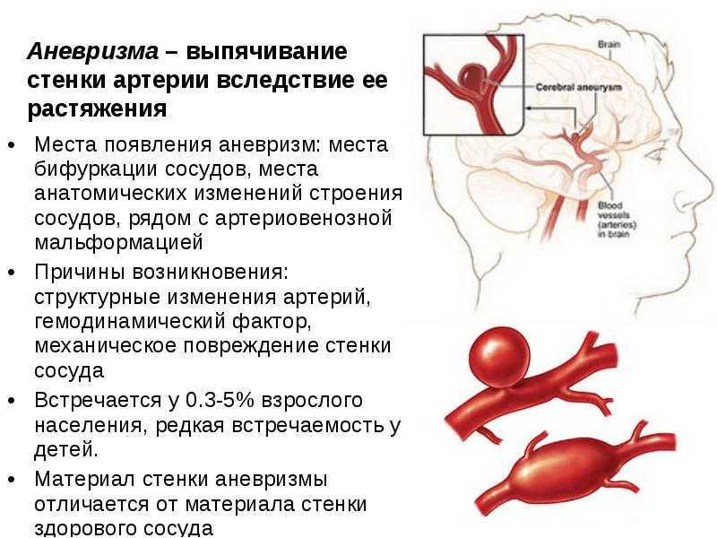 В статье под названием артерия жизни рассказывается. Аневризма сосудов головного мозга. Аневризма артерий симптоматика. Аневризма артерии головного мозга. Микроаневризма сосудов головного мозга.