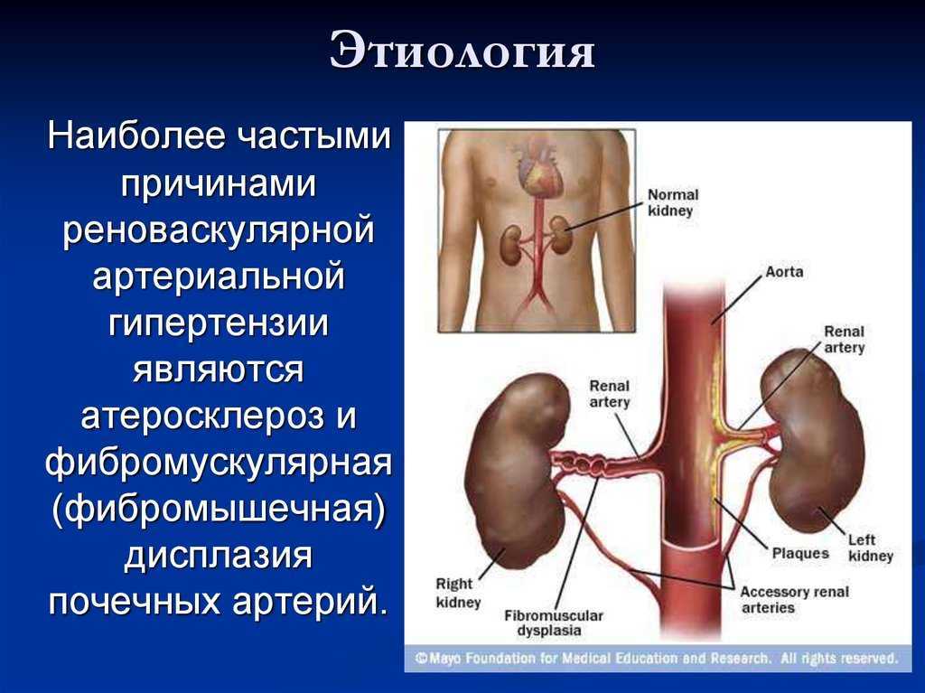 Ишемия почек. Вазоренальная почечная артериальная гипертензия. Фибромышечный стеноз почечных артерий. Стеноз почечных артерий терапия. УЗДГ почечных артерий стеноз.