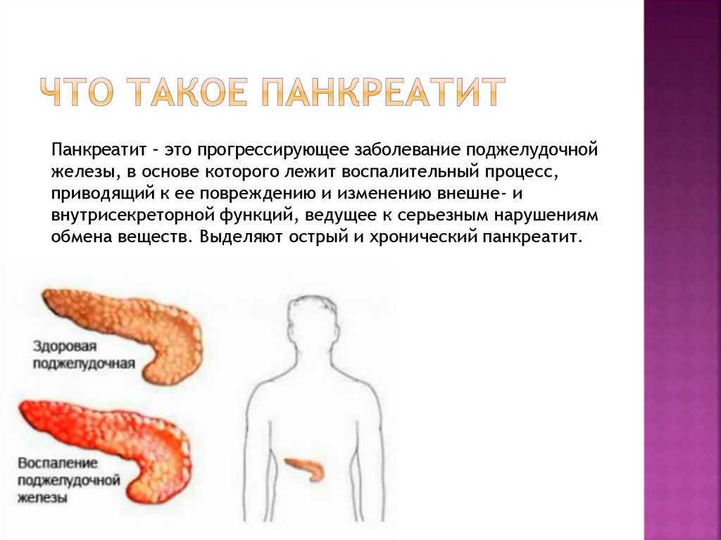 Хроническое заболевание поджелудочной железы. Болезнь поджелудочной железы панкреатин. Панкреатин поджелудочная железа. Панкреатит это заболевание. Хронический панкреатит поджелудочная железа.