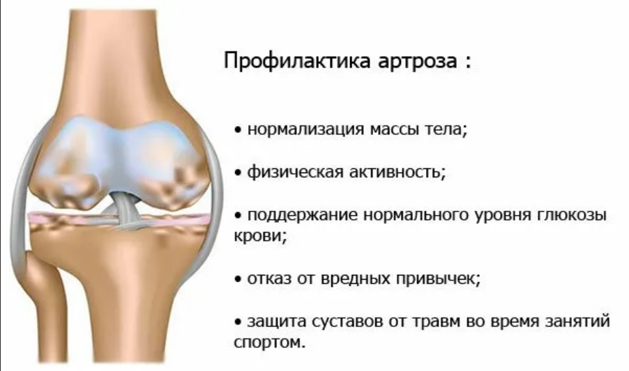 Коленный сустав по стадиям. Деформирующий артроз коленного сустава стадии. Артроз коленного сустава памятка. Профилактика артрита коленного сустава. Памятка остеоартроз коленного сустава.