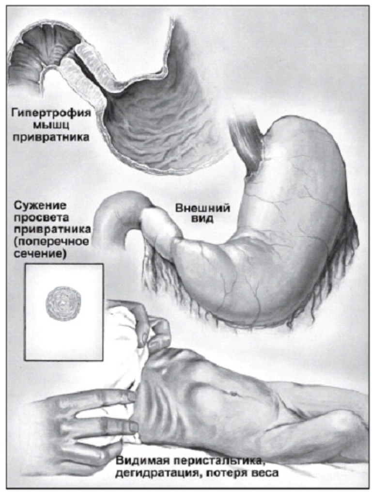 Стеноз кишечника что это. Пилорический стеноз желудка. Стеноз привратника язвы. Субкомпенсированный стеноз привратника. Язва привратника желудка рентген.