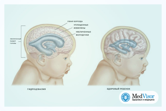 Расширение желудочков дети. Гидроцефалия желудочков головного мозга. Гидроцефалия головного мозга у грудничка. Наружная гидроцефалия головного мозга у новорожденного. Гидроцефалия норма желудочков.