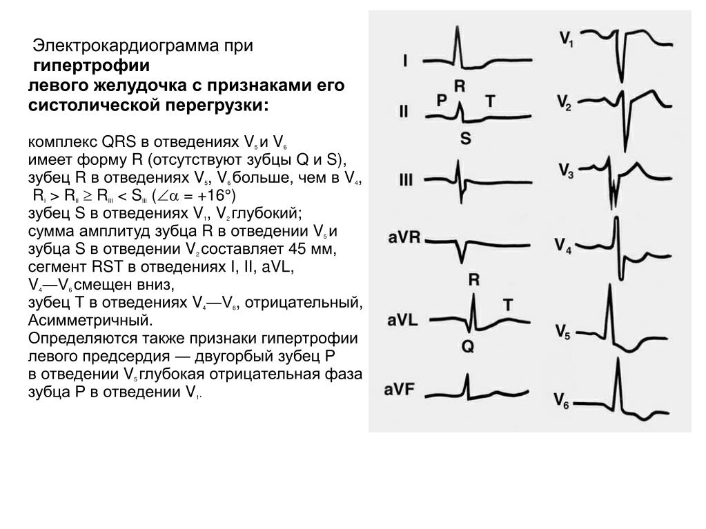 Изменения боковых отделов. Гипертрофия миокарда левого желудочка на ЭКГ. Гипертрофия желудочка сердца на ЭКГ. Электрокардиограмма при гипертрофии желудочков. ЭКГ гипертрофия левого желудочка ЭКГ.