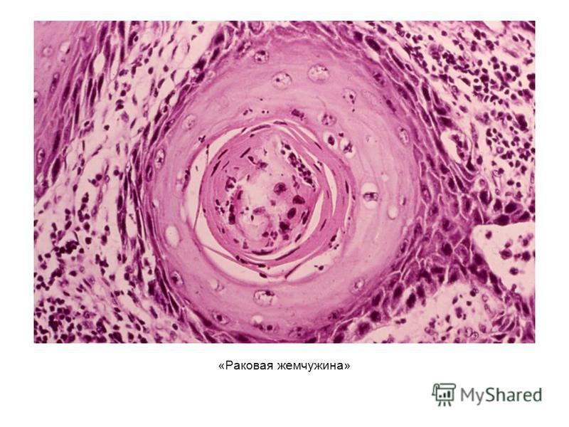 Плоскоклеточный неороговевающий рак матки