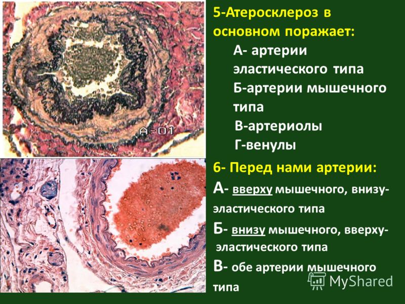 Артерий атеросклероз латынь. Атеросклероз аорты препарат патанатомия. Атеросклероз артерий гистология.