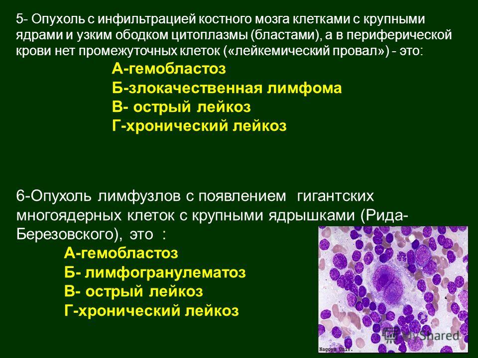 Злокачественные новообразования лимфоидной кроветворной ткани. Гемобластозы клинико морфологическая. Морфологическая характеристика лейкозов. Гемобластозы лейкозы. Классификация гемобластозов.