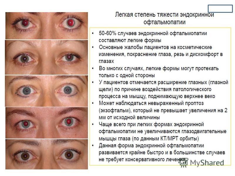 Признаки больных глаз. Эндокринная офтальмопатия. Симптомы офтальмопатии. Эндокринная офтальмопатия глазные симптомы. Симптомы эндокринной офтальмопатии.