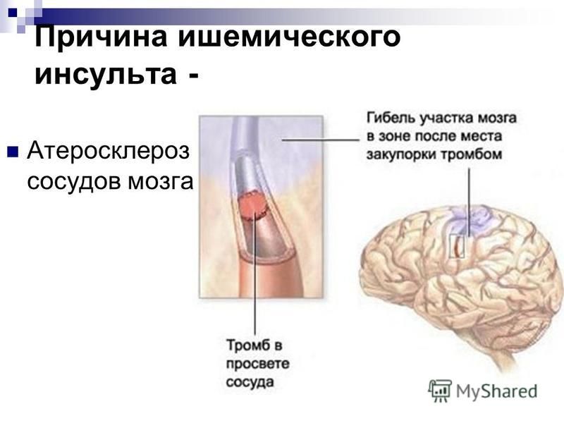 Правосторонний ишемический инсульт головного мозга. Причины ишемич инсульта. Предпосылки ишемического инсульта. Причины ишемического инсульта головного мозга.