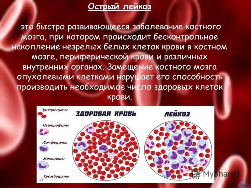 Хронические заболевания крови. Острый лимфобластный лейкоз кровь. Leikoz. Болезнь крови лейкемия.