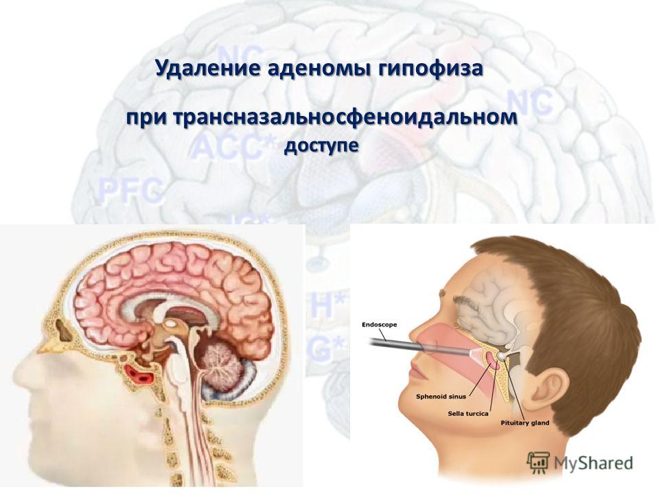 Аденома гипофиза головного мозга фото