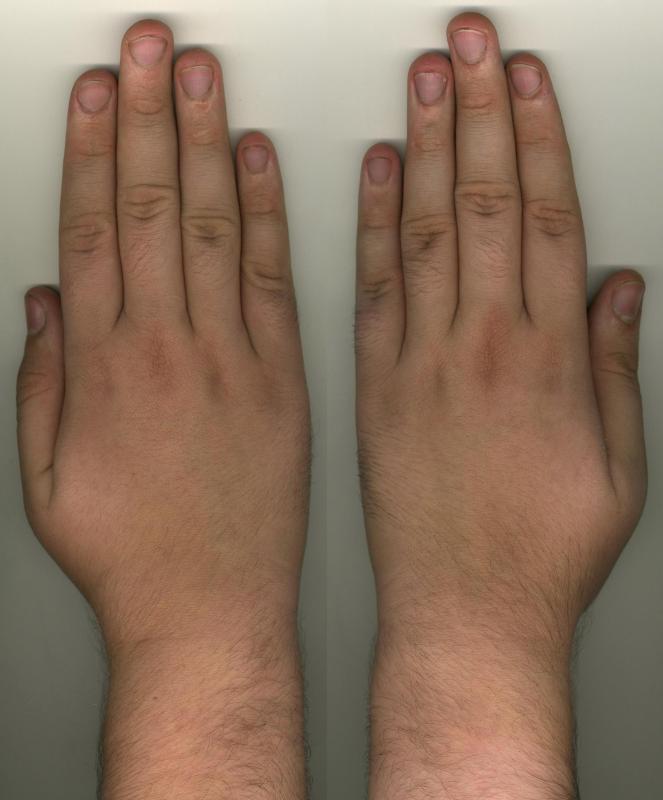 Изменение формы руки. Темные пятна на костяшках пальцев рук. Потемнение кожи на кисти руки.