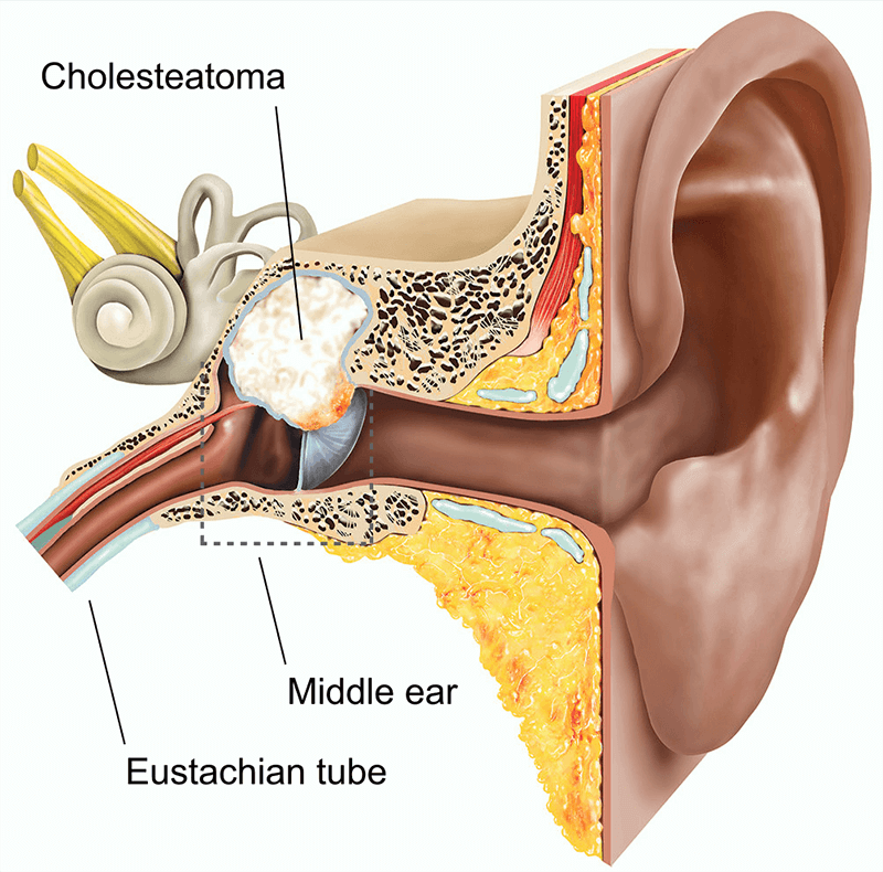 Холестеатома барабанной полости кт. Холестестеатома отоскопия. Холестеатома уха операция.