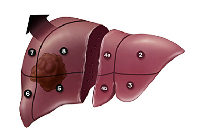 При гемангиоме печени можно ли. Гемангиома печени Liver resection. Гемангиома печени (Liver Hemangioma).