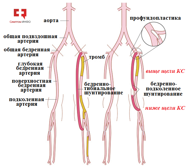 Операция на артерии нижних
