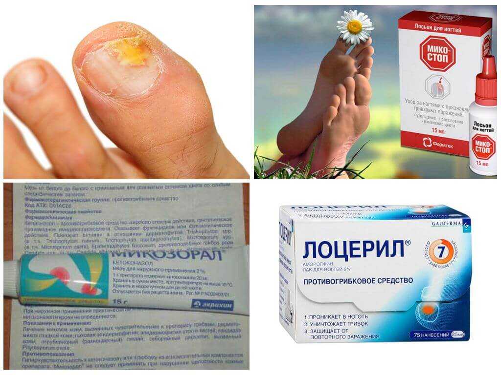 Грибок стопы лечение препараты эффективные отзывы. Лекарство от грибка ногтей на ногах. Лекарства от грибка стоп и ногтей.